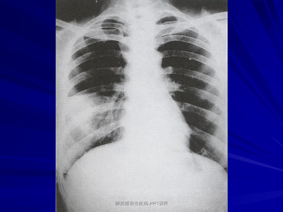 肺部感染性疾病PPT课件_第2页