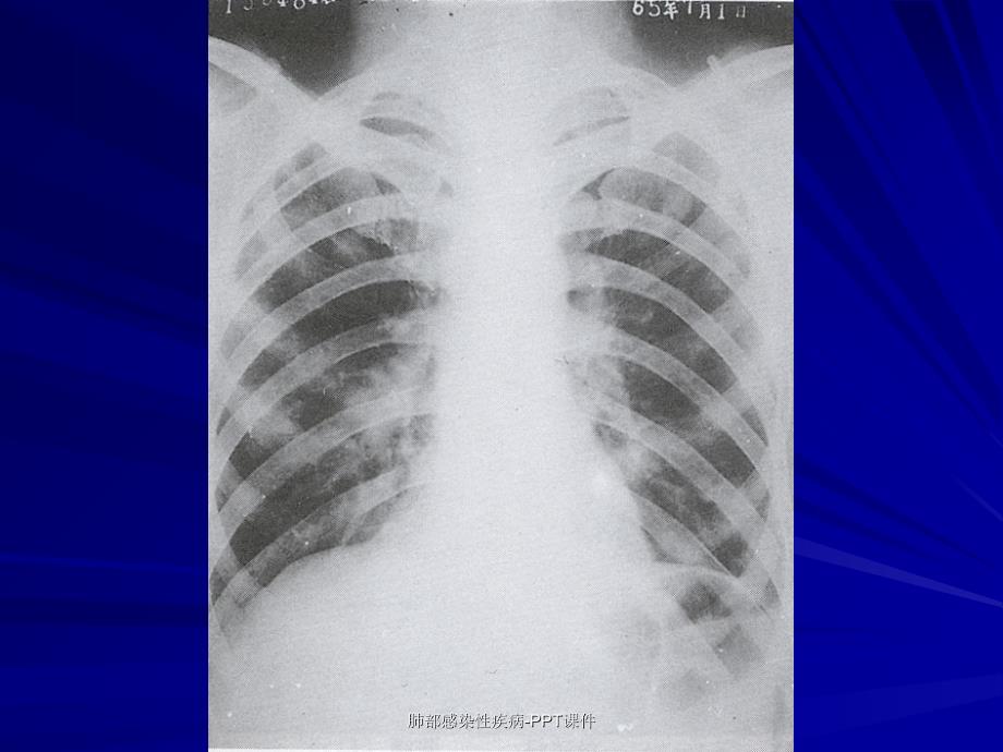 肺部感染性疾病PPT课件_第3页