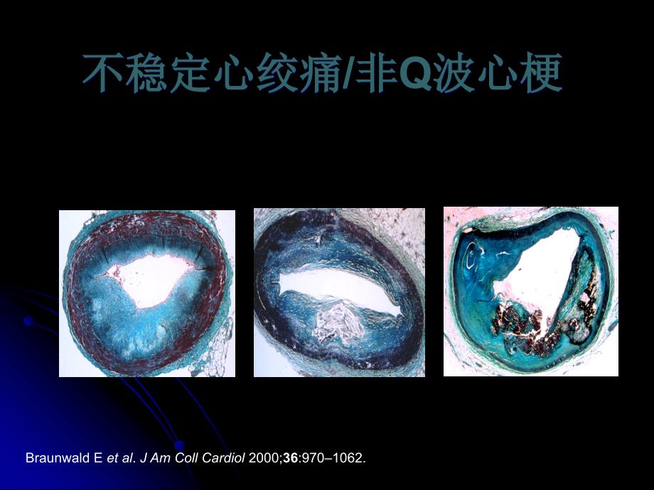 ACS诊断与危险性评估曾定尹_第3页