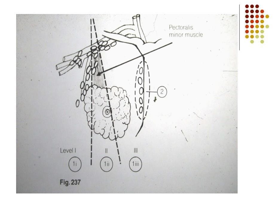 乳腺癌放射治疗_第5页