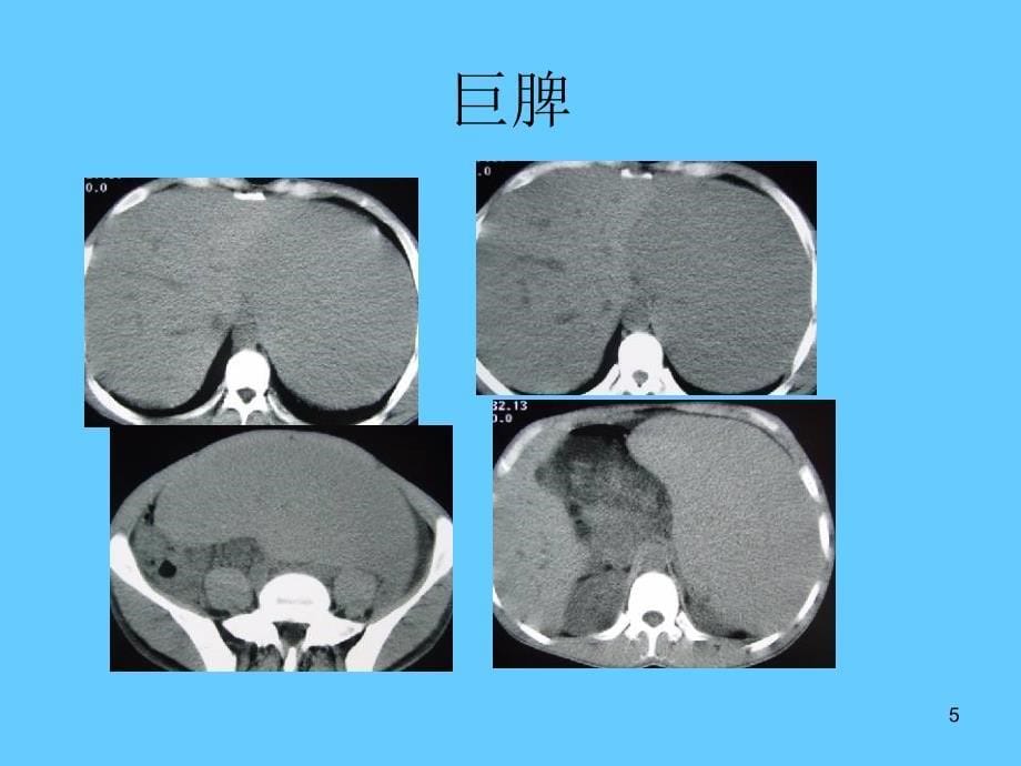 脾脏疾病的CT诊断ppt课件_第5页