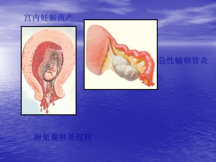 妇科急腹痛诊治思路_第4页