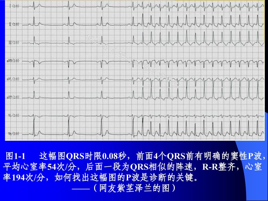 P波的识别与相关病例讨.资料_第3页