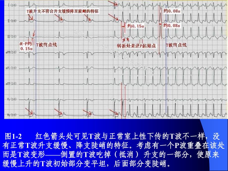 P波的识别与相关病例讨.资料_第4页