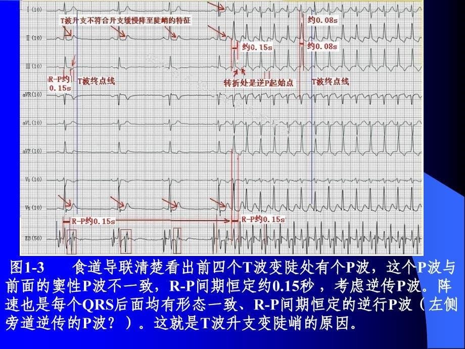 P波的识别与相关病例讨.资料_第5页