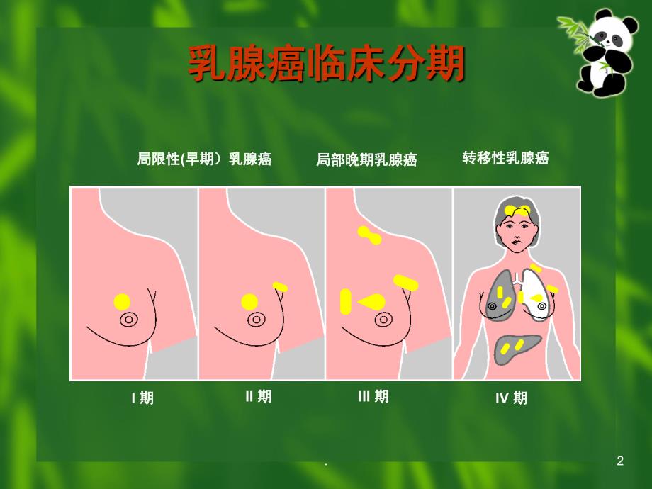 乳腺癌TNM分期课堂PPT_第2页