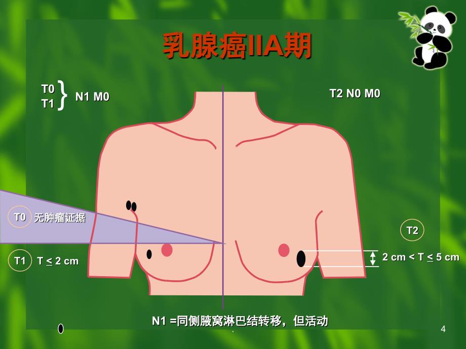 乳腺癌TNM分期课堂PPT_第4页