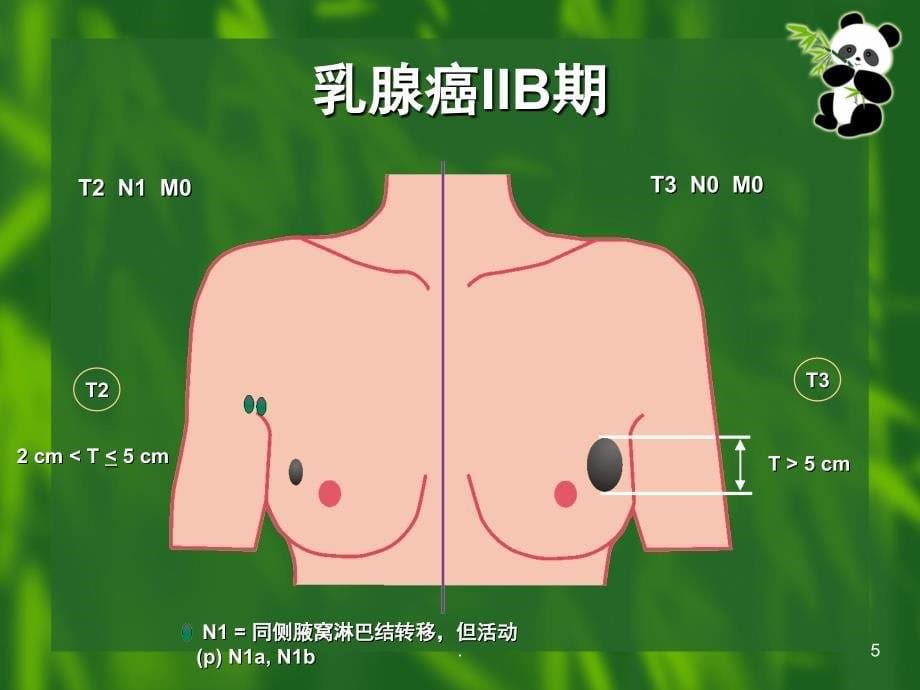 乳腺癌TNM分期课堂PPT_第5页