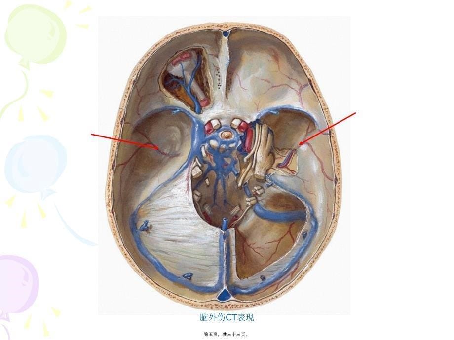 脑外伤CT表现课件_第5页