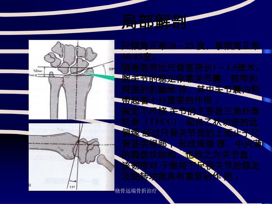 桡骨远端骨折治疗_第3页