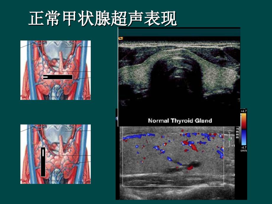 甲状腺癌的超声检查_第2页