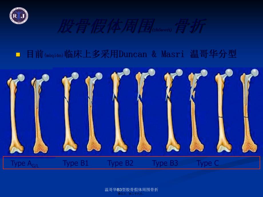 温哥华B3型股骨假体周围骨折课件_第3页