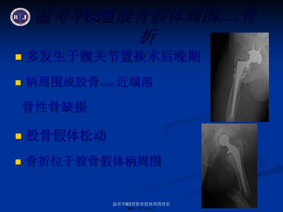 温哥华B3型股骨假体周围骨折课件_第4页