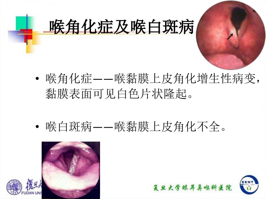 耳鼻咽喉-头颈外科学：喉角化症及喉白斑病喉淀粉样变声带息肉和声带小结喉创伤喉神经及精神性疾病_第3页