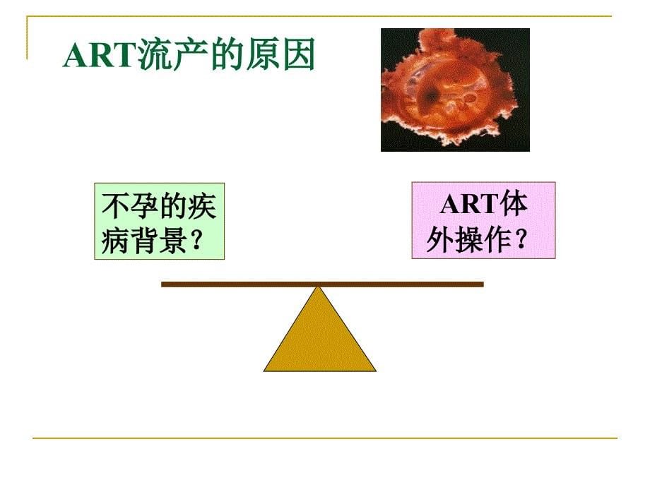 复发性流产诊治进展和辅助生殖技术课件_第5页