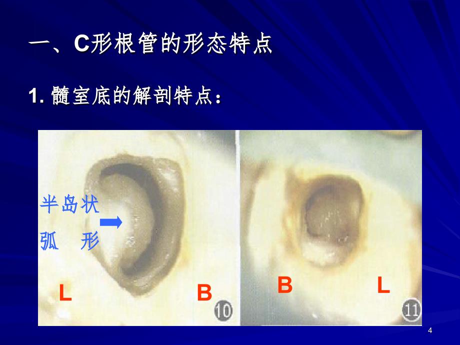 C形根管的形态识别和治疗.ppt_第4页