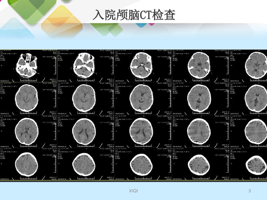 急性脑梗死动脉取栓治疗_第3页