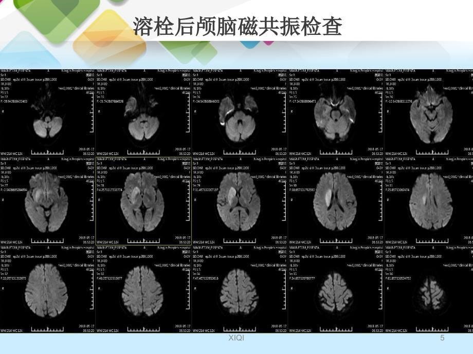 急性脑梗死动脉取栓治疗_第5页