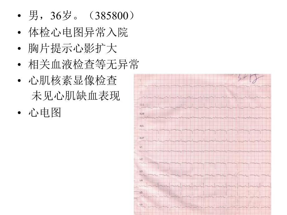 房间隔缺损合并心肌病的治疗教学课件_第2页