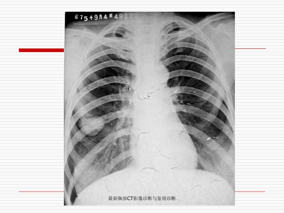 胸部CT影像诊断与鉴别诊断_第3页