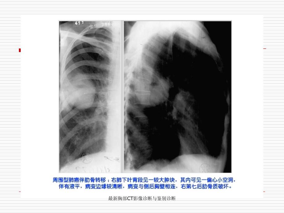 胸部CT影像诊断与鉴别诊断_第4页