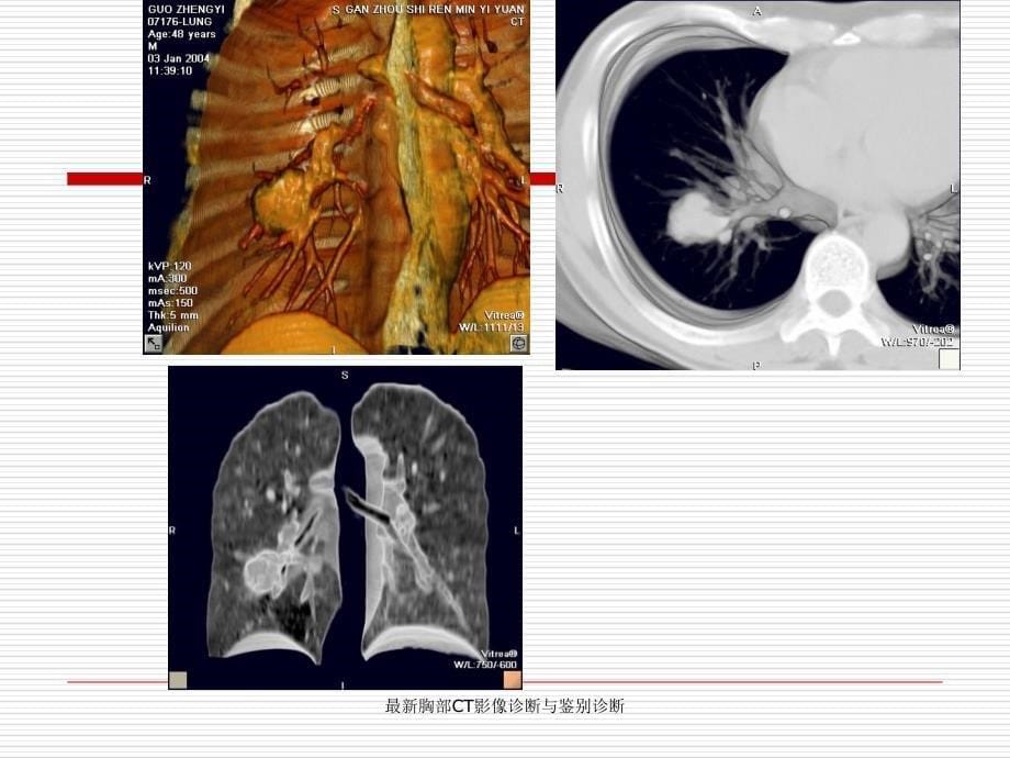 胸部CT影像诊断与鉴别诊断_第5页