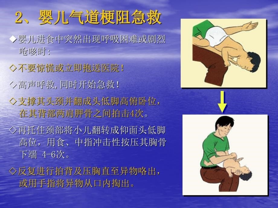 气道异物梗塞与溺水急救.ppt_第5页