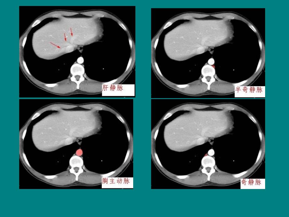 腹部CT诊断(很经典)_第4页
