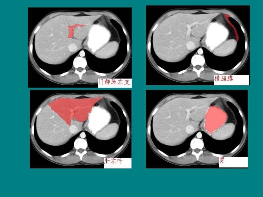 腹部CT诊断(很经典)_第5页
