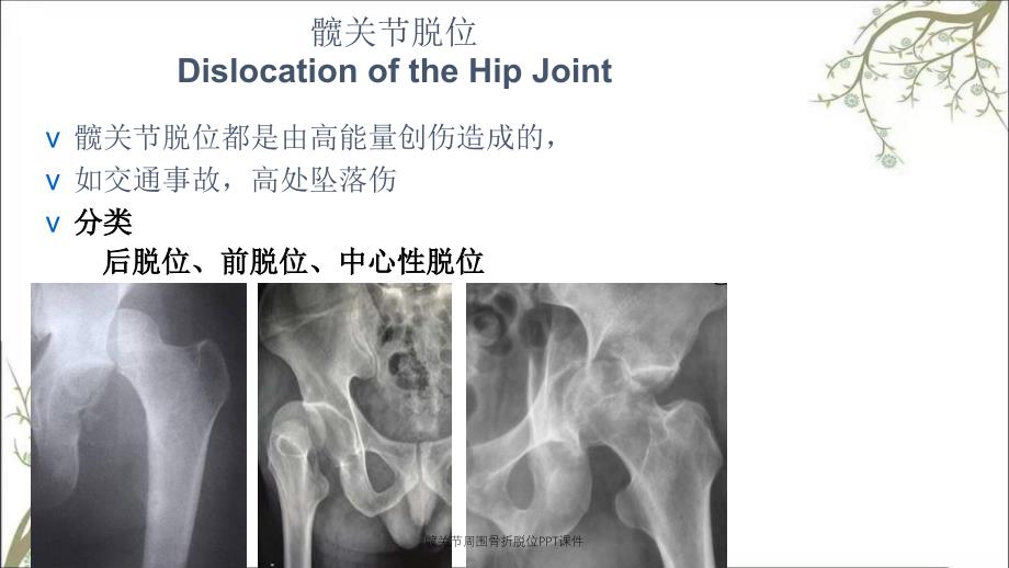 髋关节周围骨折脱位PPT课件_第4页