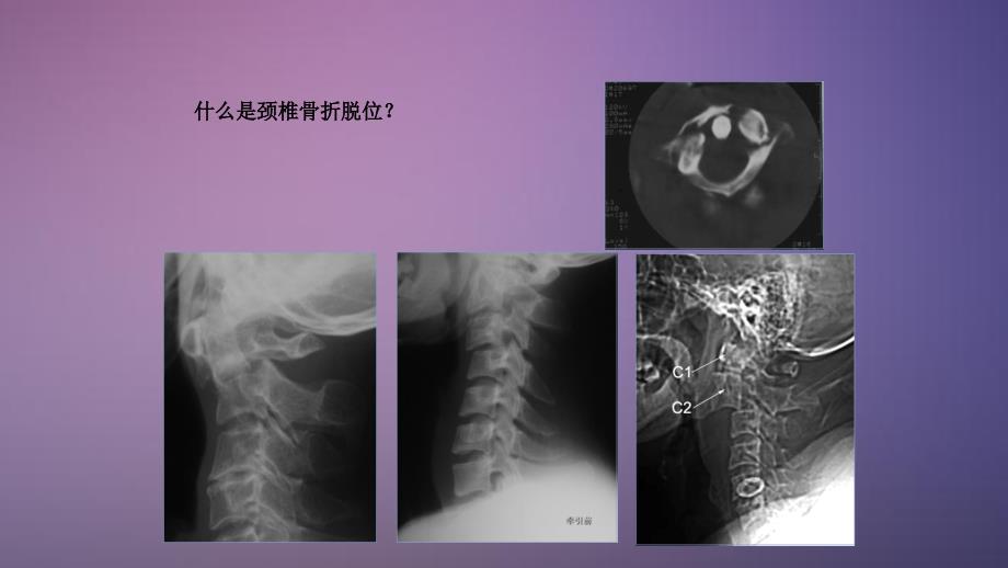 颈椎骨折护理干货分享_第3页