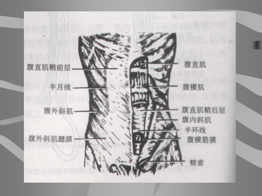 外科手术腹壁切口课件_第5页