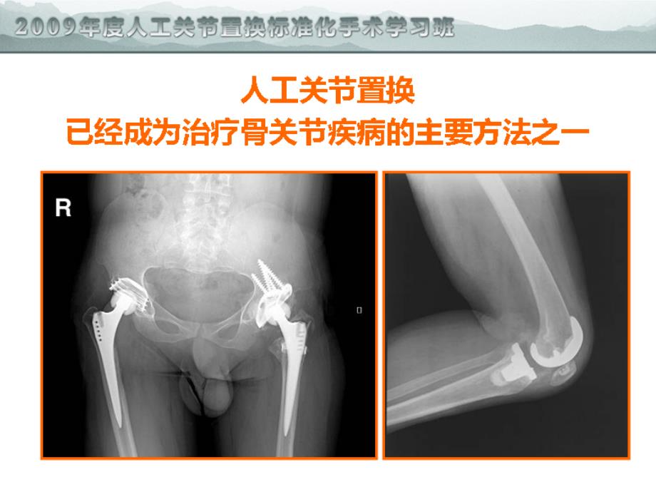 关节置换的围手术期精细化管理ppt课件_第2页