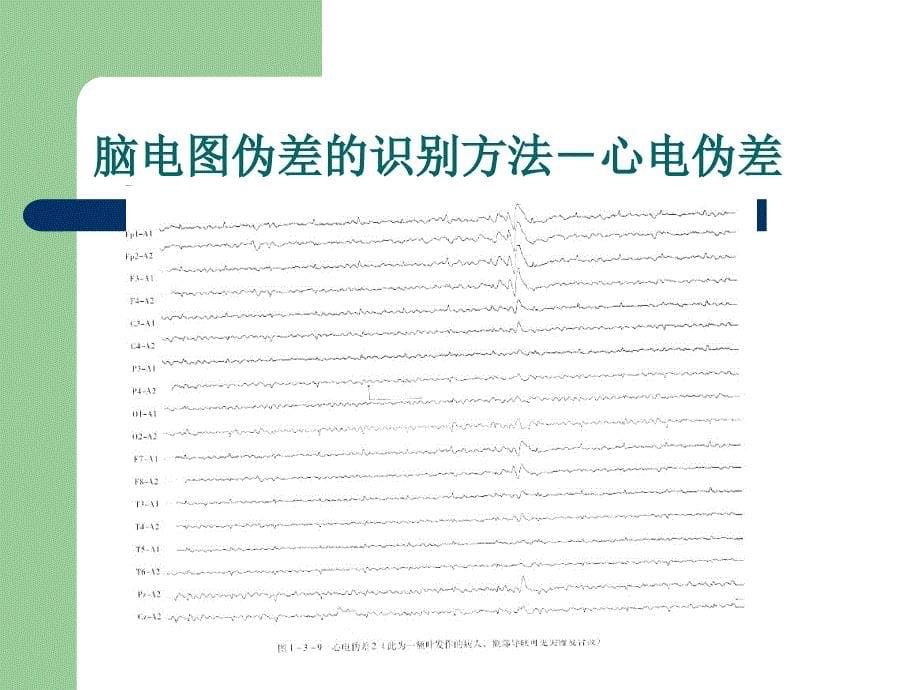 脑电图伪差的识别方法.ppt_第5页