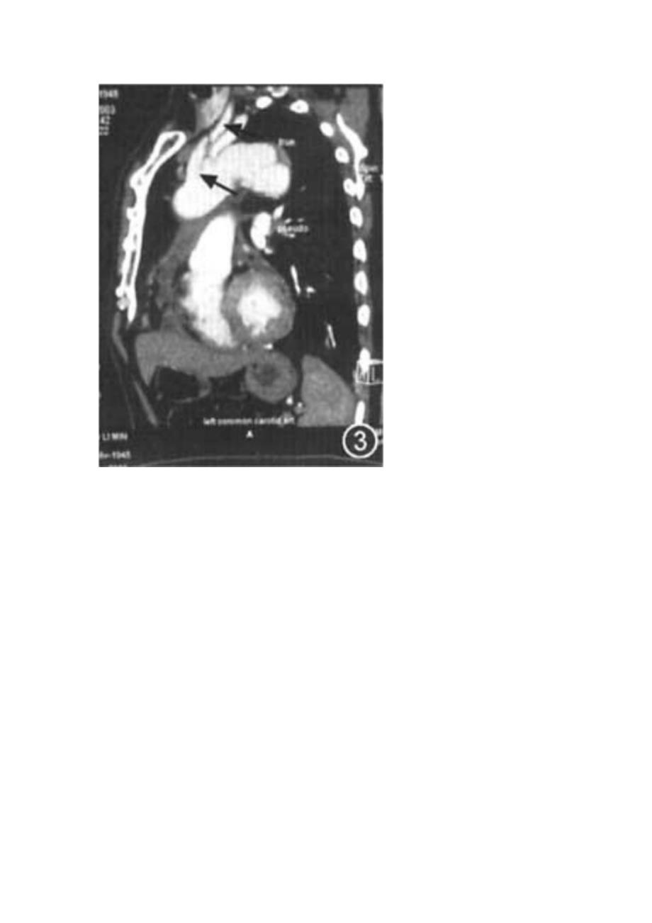 主动脉夹层病历分析 (2).doc_第3页
