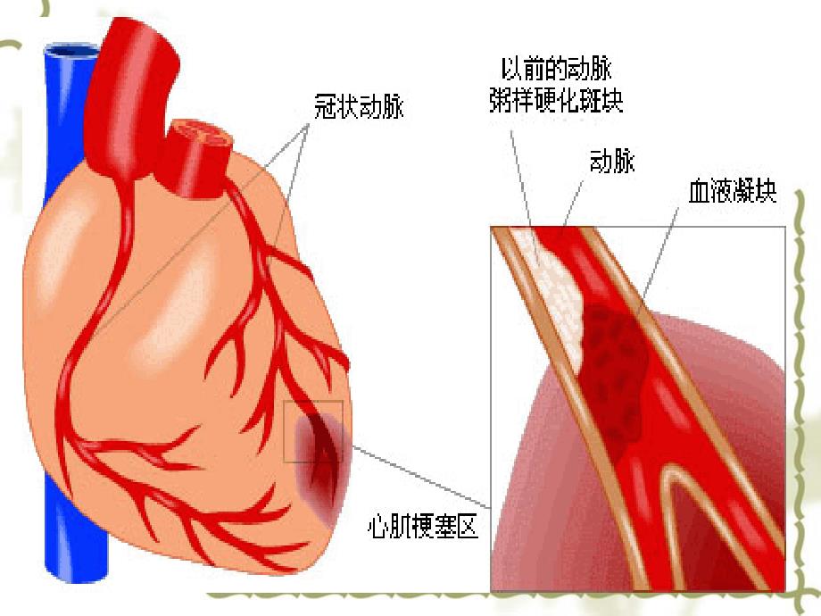 急性心肌梗死的急救护理_第2页