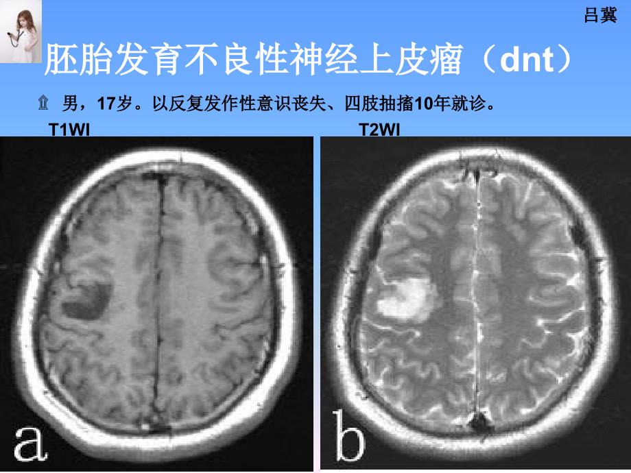 医影在线CNS疾病影像图库2_第2页