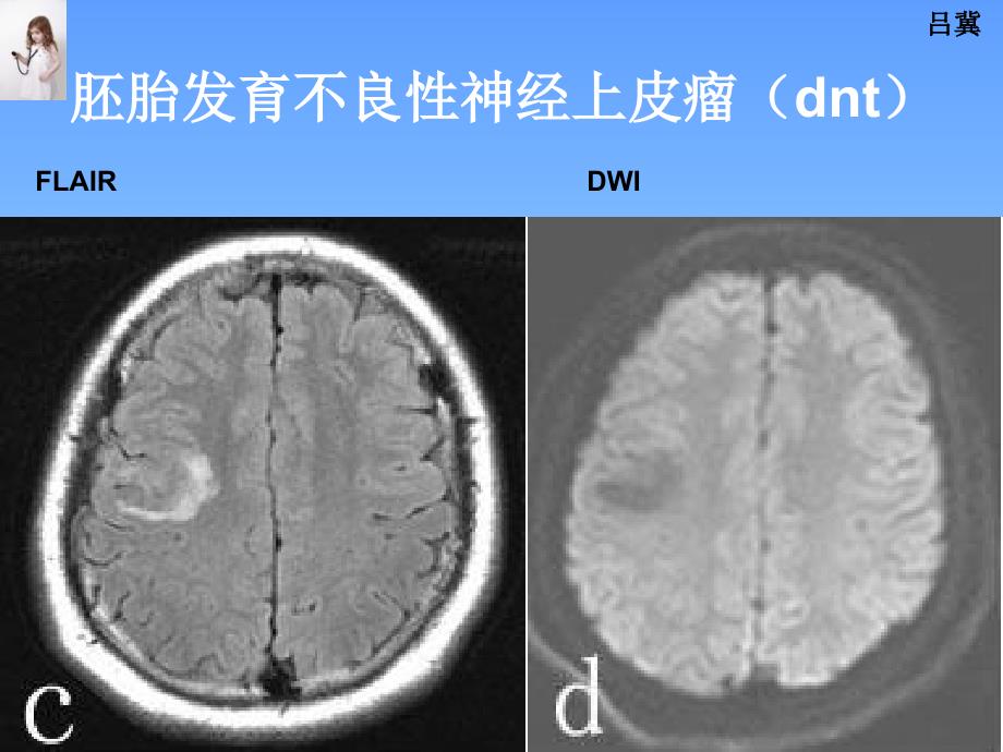 医影在线CNS疾病影像图库2_第3页