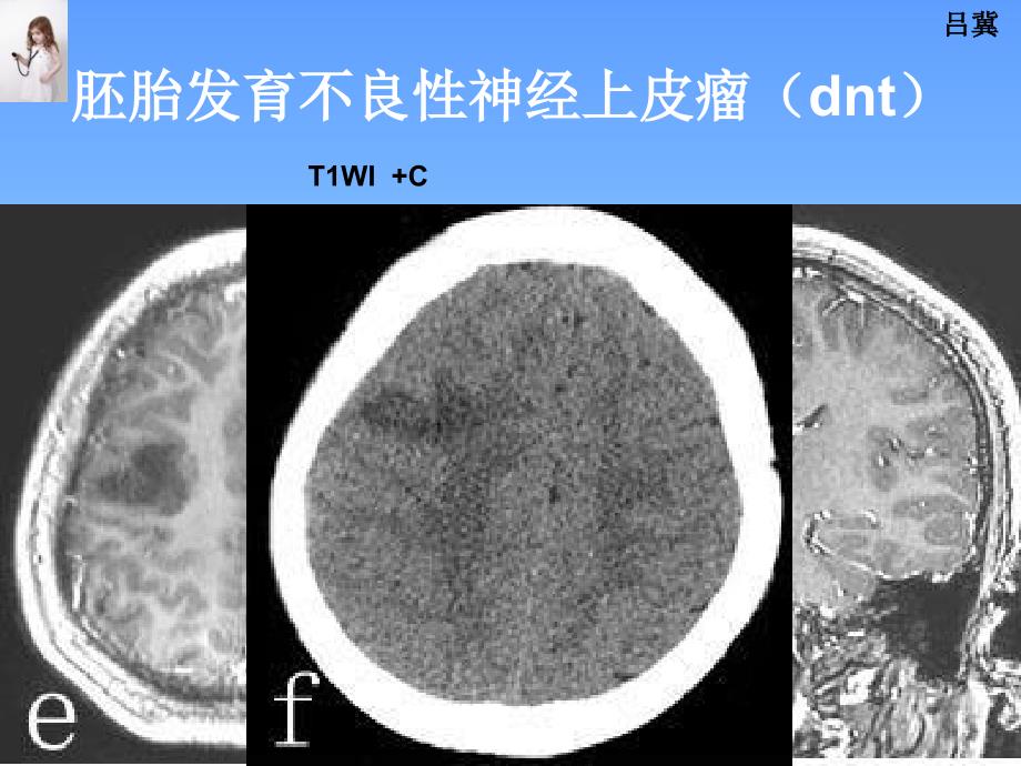 医影在线CNS疾病影像图库2_第4页