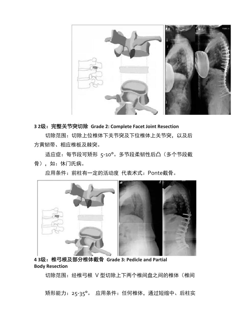 脊柱截骨术分级_第2页