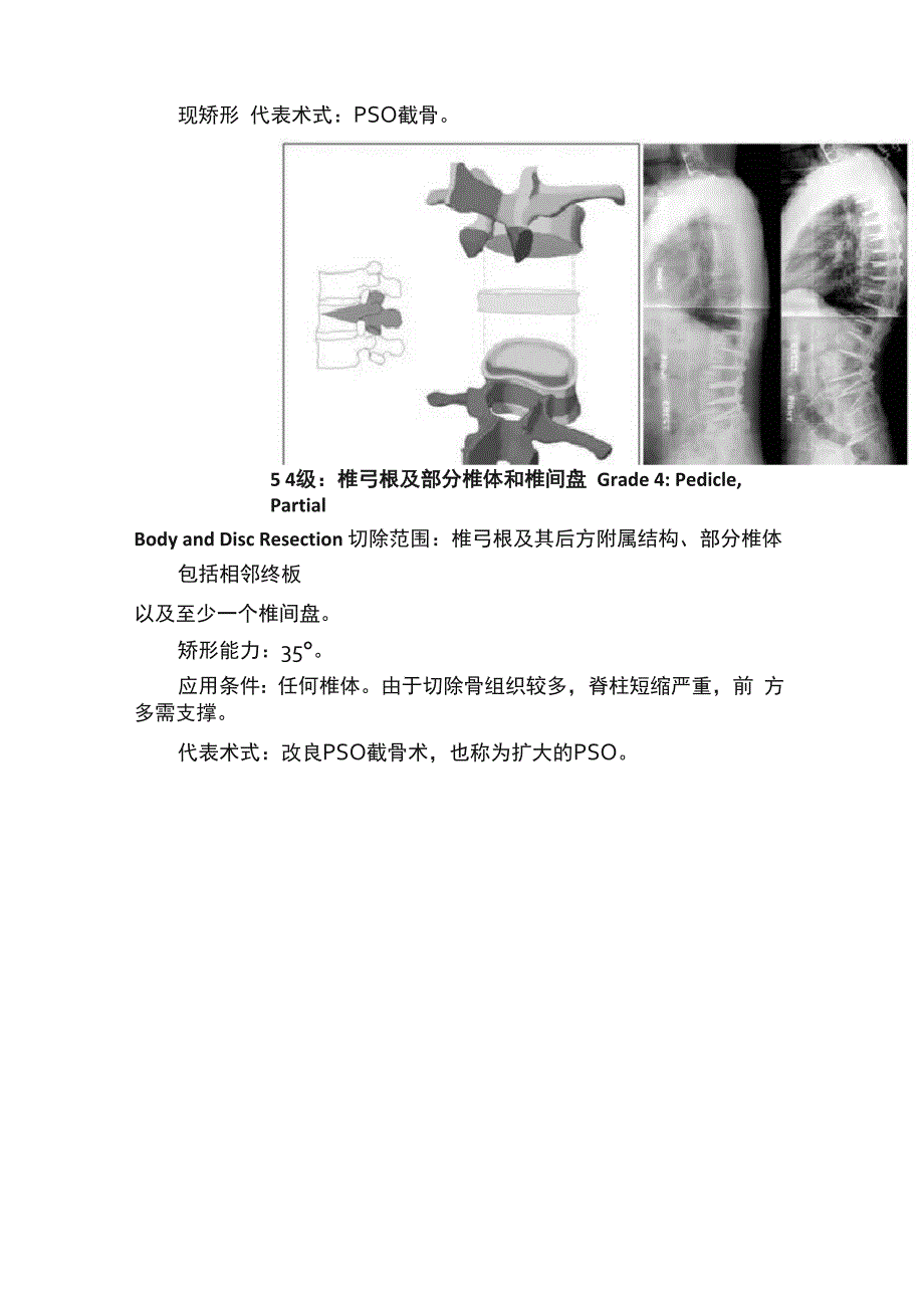 脊柱截骨术分级_第3页