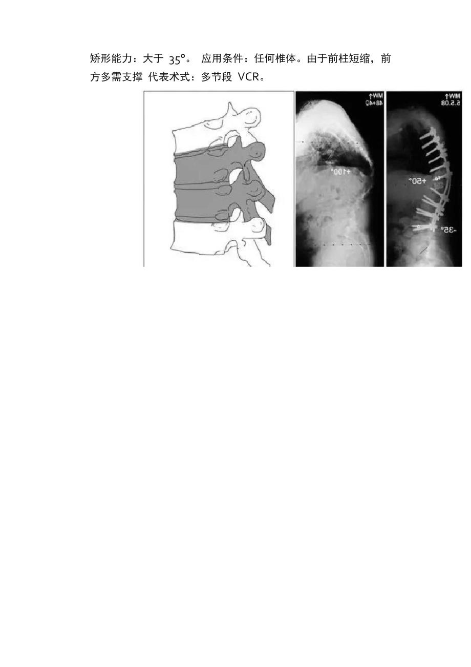 脊柱截骨术分级_第5页