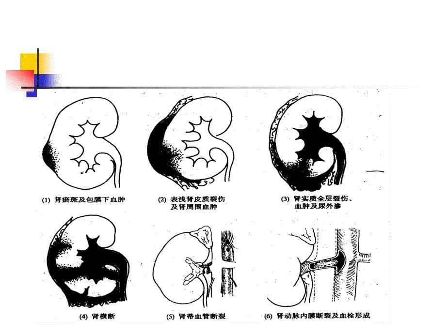 第三十九章泌尿系统损伤病人的护理_第5页