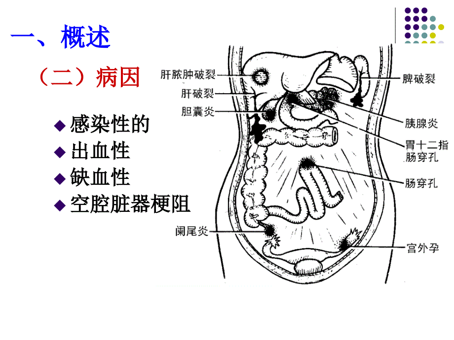 外科护理学急腹症_第4页