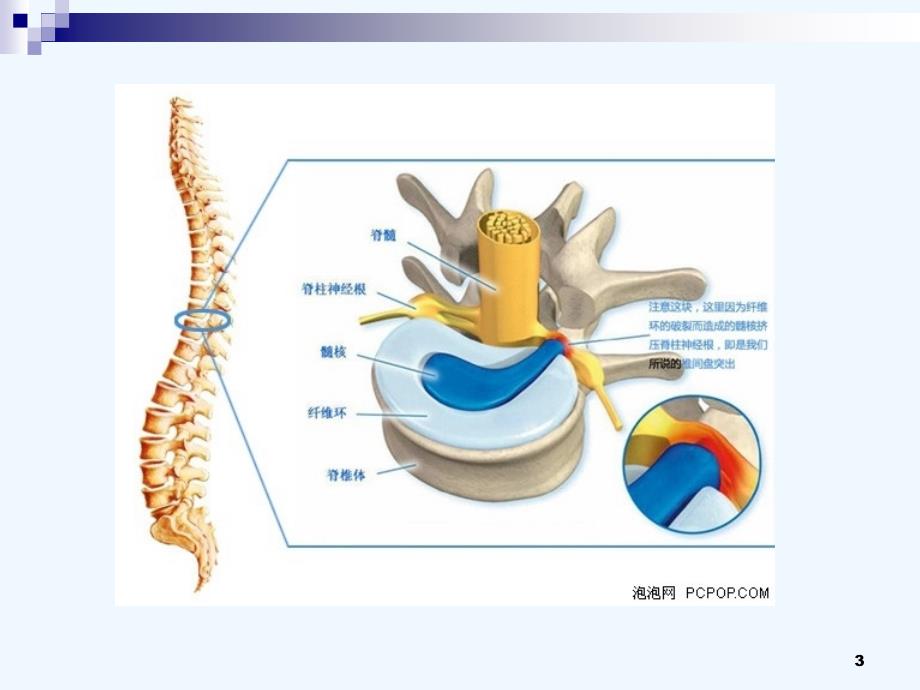 腰椎间盘突出影像诊断课件_第3页