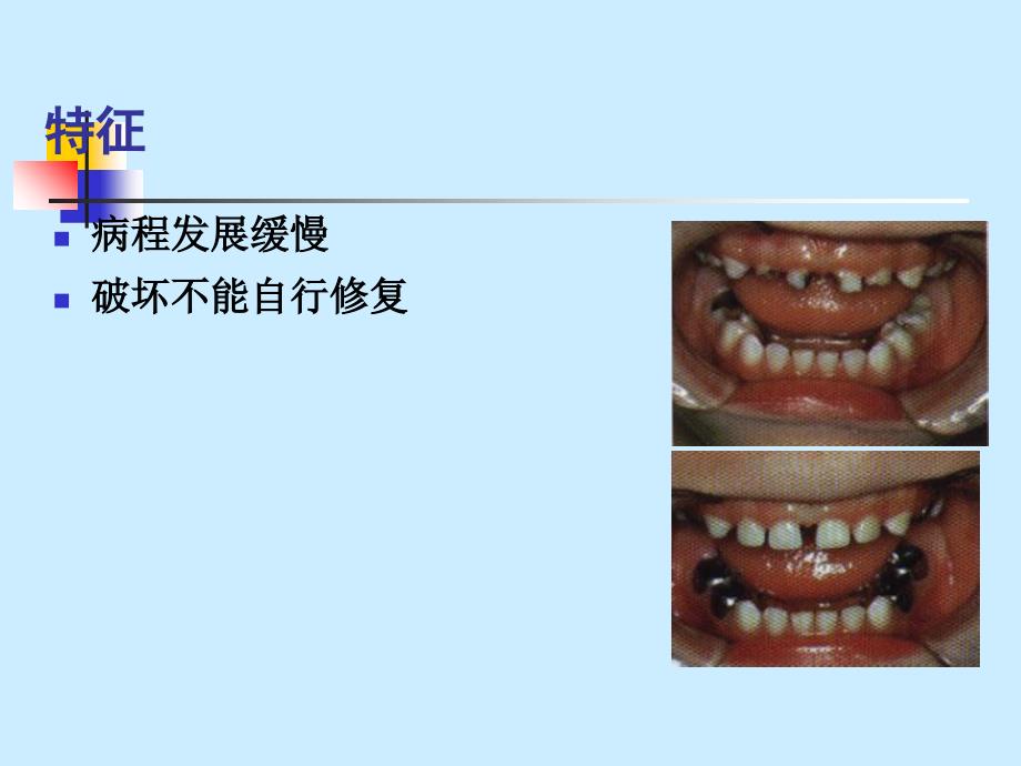 龋病病因、临床表现、诊断、鉴别诊断_第3页