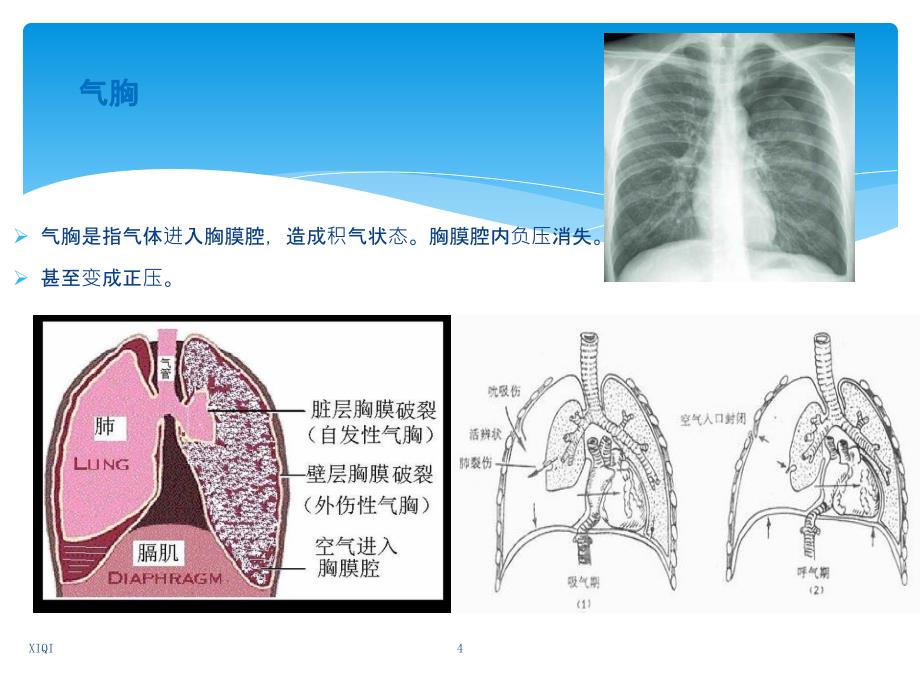 胸腔穿刺术 实用讲解_第4页