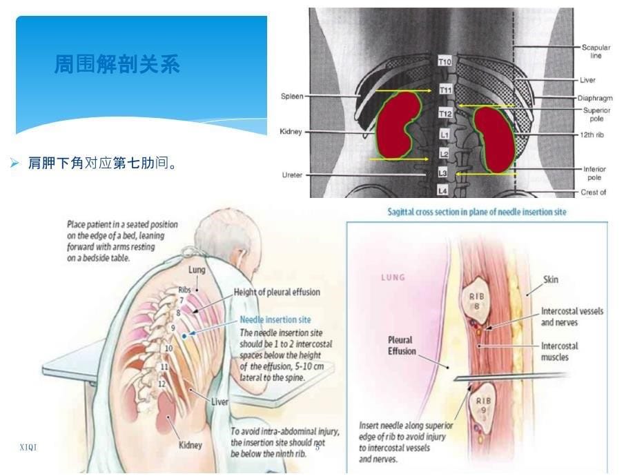 胸腔穿刺术 实用讲解_第5页