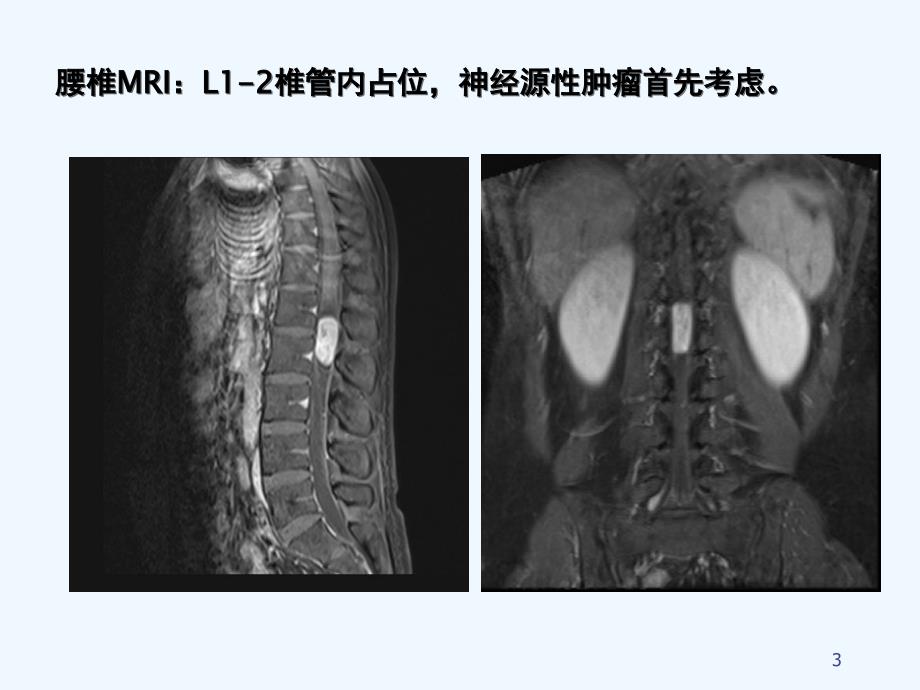 椎管内肿瘤课件_第3页