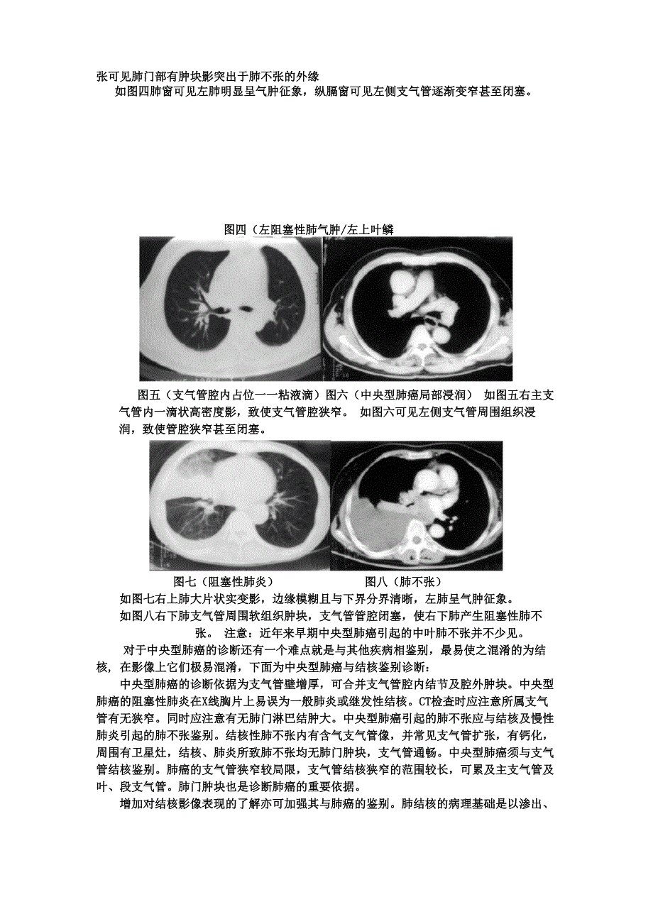中央型肺癌_第3页